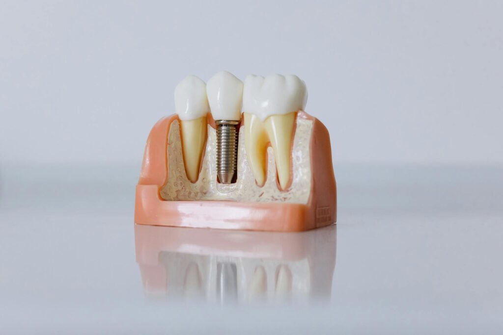 Quando e come scegliere un dente provvisorio?