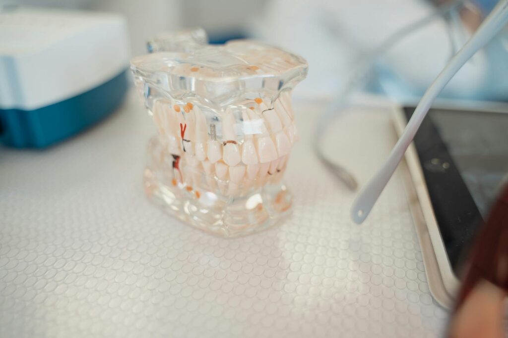 Cosa fare se l’impianto dentale si muove?