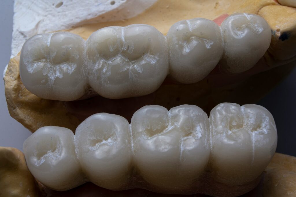 Perché dovresti consultare un dentista se ti ritrovi a digrignare i denti