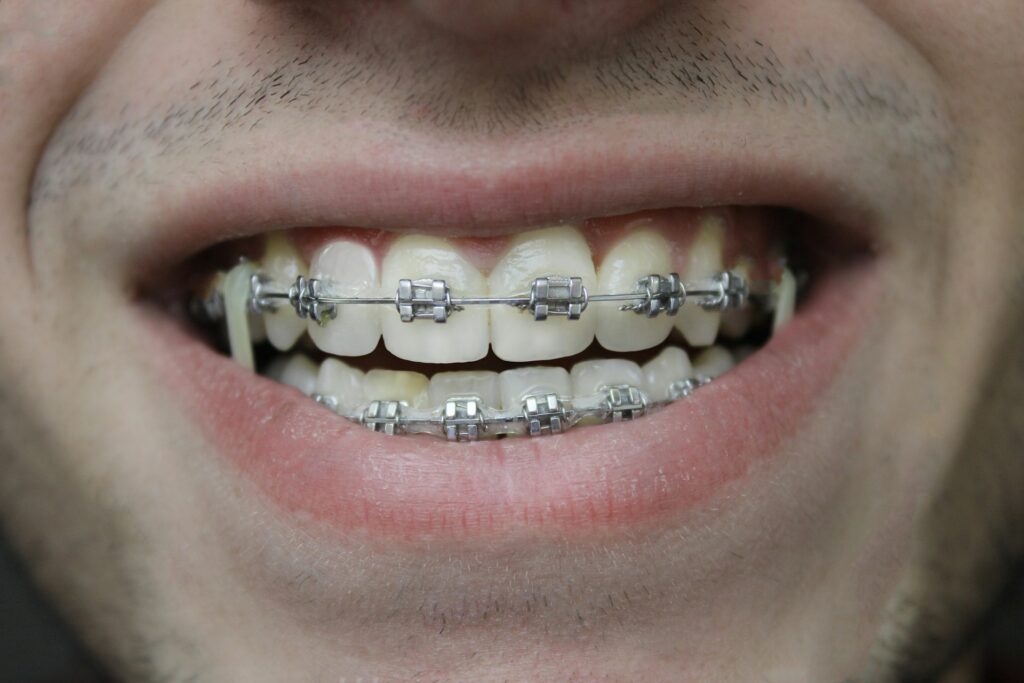 Sorriso e mala occlusione: cosa c’è da sapere
